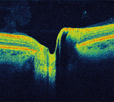 Cirrus OCT Aufnahme mit dunklem Hintergrund und grünen, gelben, blauen, orangen Formen