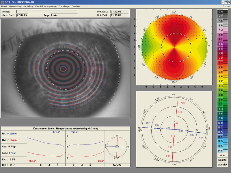 Keratograph Aufnahme: Messergebnisse werden anhand von Computergrafiken wie Kreisen und Graphen visualisiert