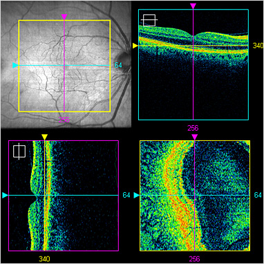 Netzhaut Screening: OCT-Visualisierung unterteilt in 4 Bereiche, 3 davon bestehend aus grünen, blauen, orangen Formen.