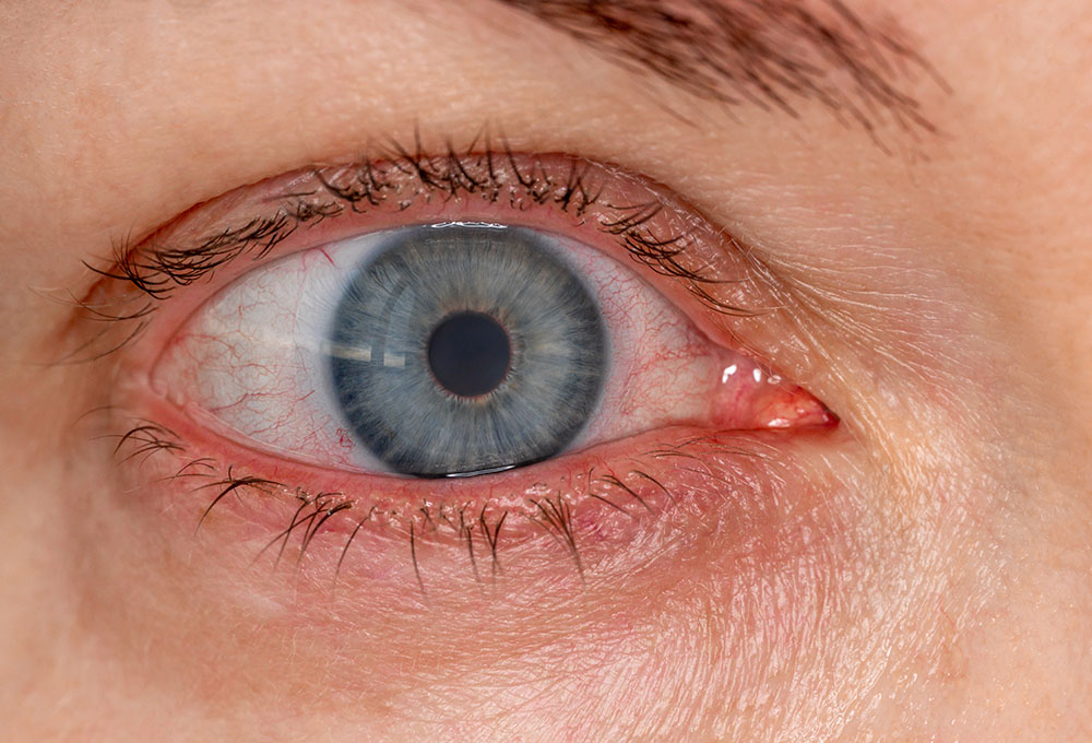 Männliches blaues Auge mit Rötungen