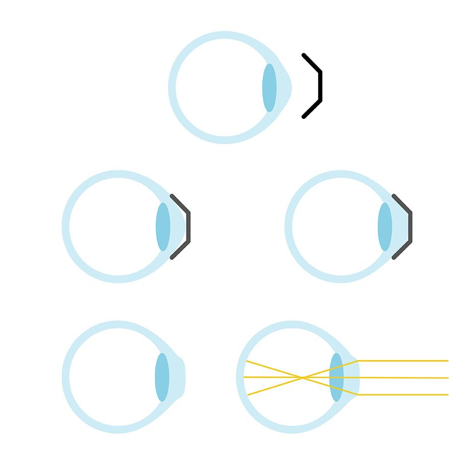 Wirkungsweise der Ortho-K-Linsen wird anhand von Augen-Illustration veranschaulicht