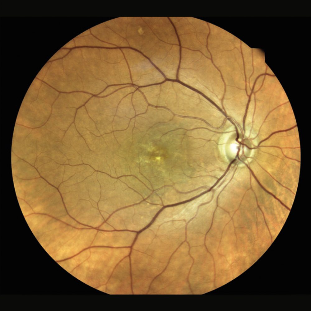 Fluoreszenzangiographie Aufnahme - Augenhintergrund mit sichtbaren Gefäßen